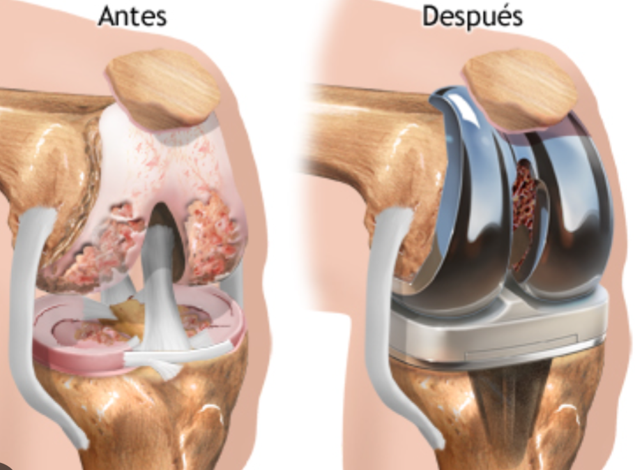 Rodilla antes y después de la artroplastía
