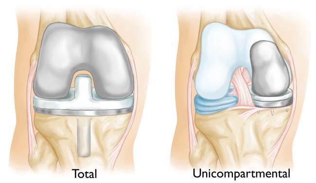 Comparación de prótesis total vs unicompartimental de rodilla